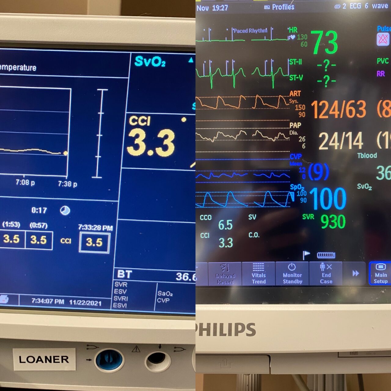 Recovering CABG & Cardiac/Heart Surgery Patients in the CVICU