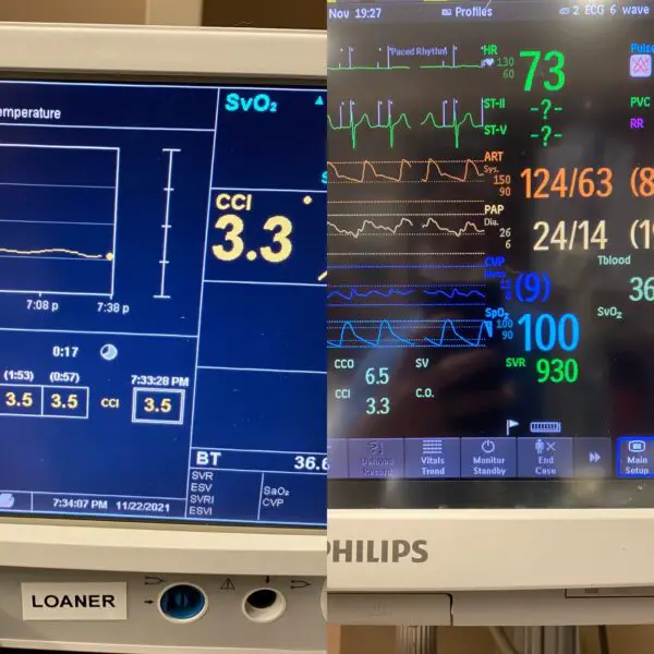 Recovering CABG & Cardiac/Heart Surgery Patients in the CVICU